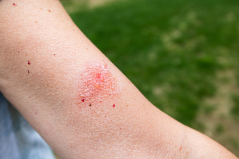 what does poison ivy rash look like