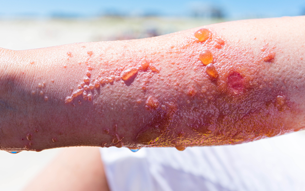 what does poison ivy rash look like